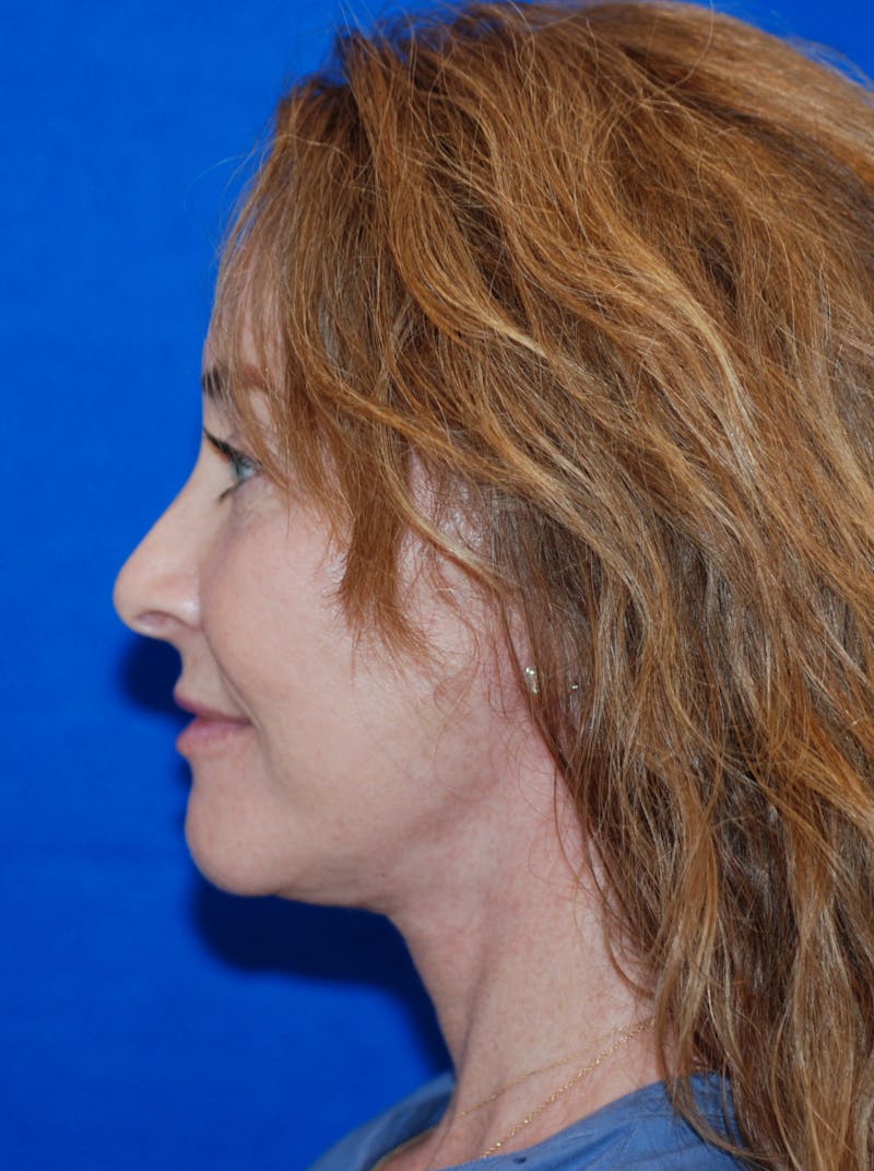 Facelift Before & After Gallery - Patient 994875 - Image 8