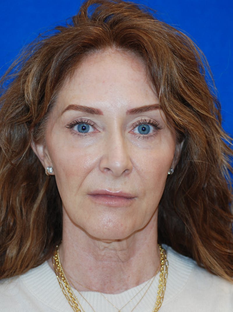 Facelift Before & After Gallery - Patient 994875 - Image 3