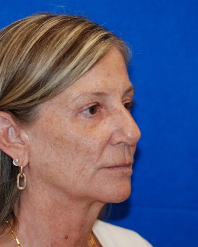 Eyelid Surgery Before & After Gallery - Patient 302087 - Image 6