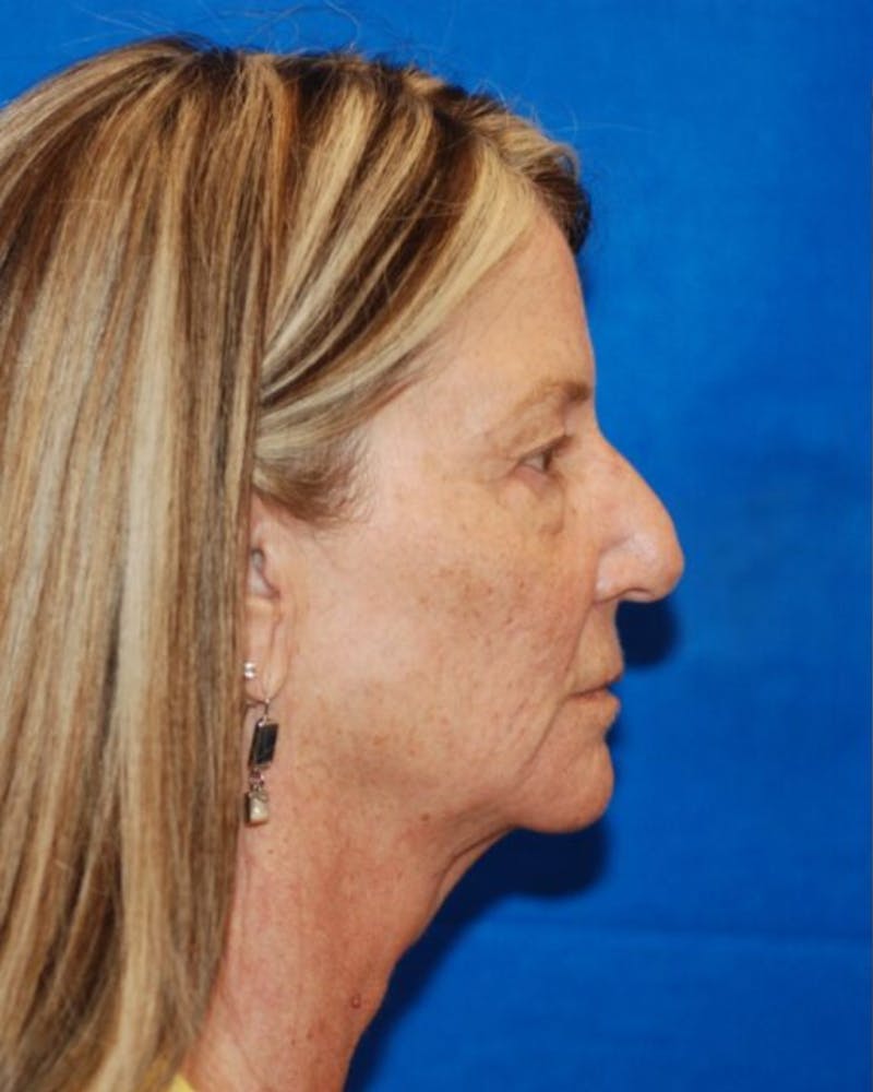 Eyelid Surgery Before & After Gallery - Patient 302087 - Image 3