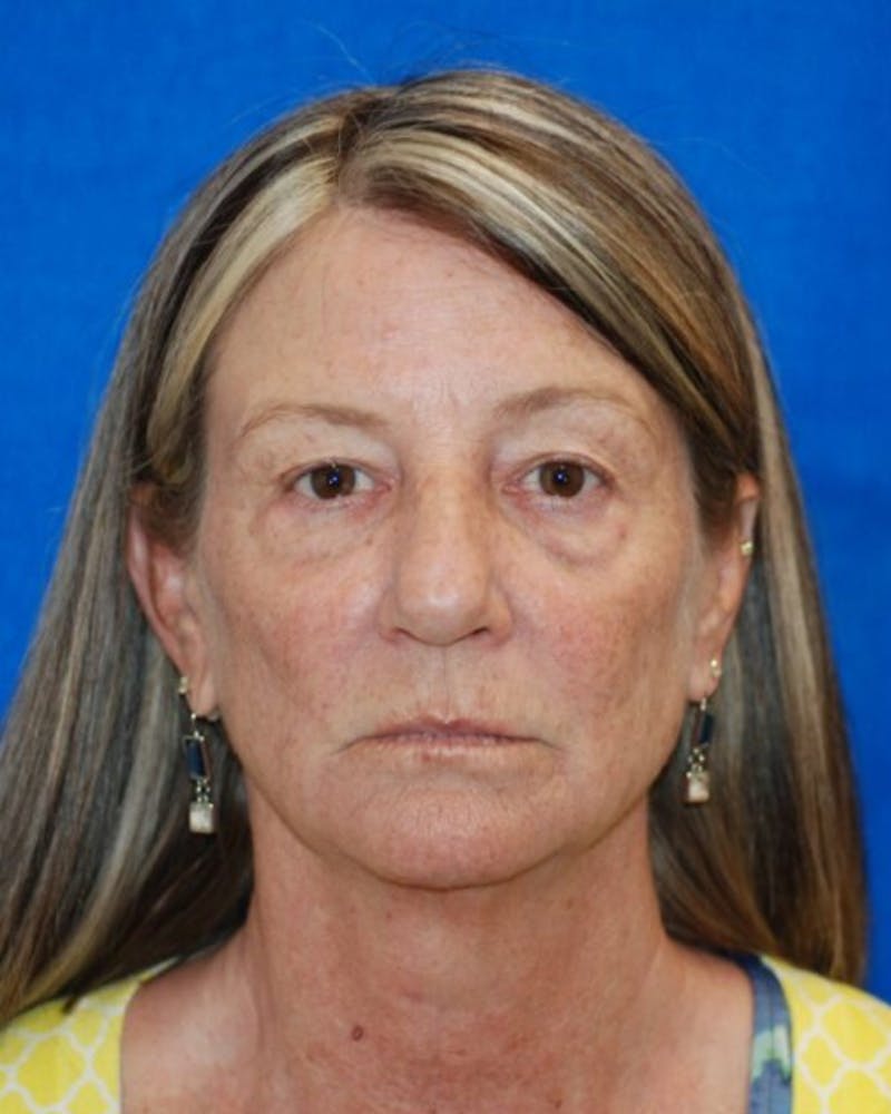 Eyelid Surgery Before & After Gallery - Patient 302087 - Image 1