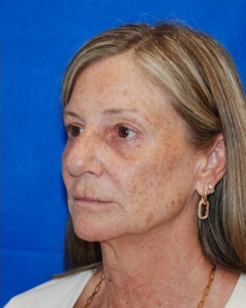 Eyelid Surgery Before & After Gallery - Patient 302087 - Image 8