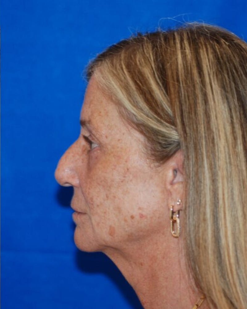 Eyelid Surgery Before & After Gallery - Patient 302087 - Image 10