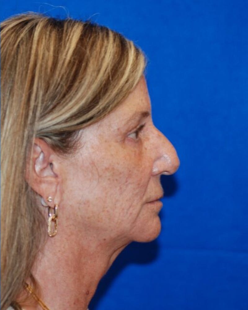 Eyelid Surgery Before & After Gallery - Patient 302087 - Image 4