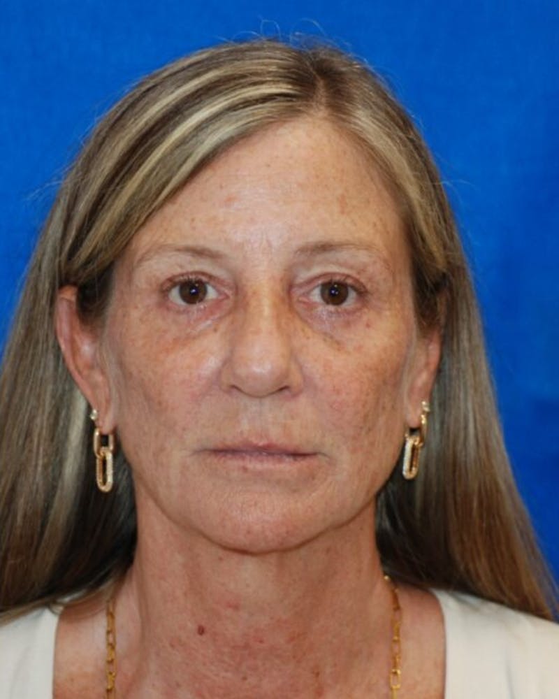 Eyelid Surgery Before & After Gallery - Patient 302087 - Image 2