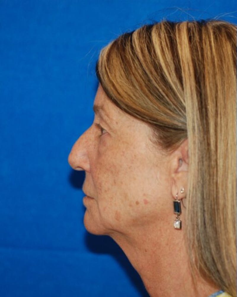 Eyelid Surgery Before & After Gallery - Patient 302087 - Image 9