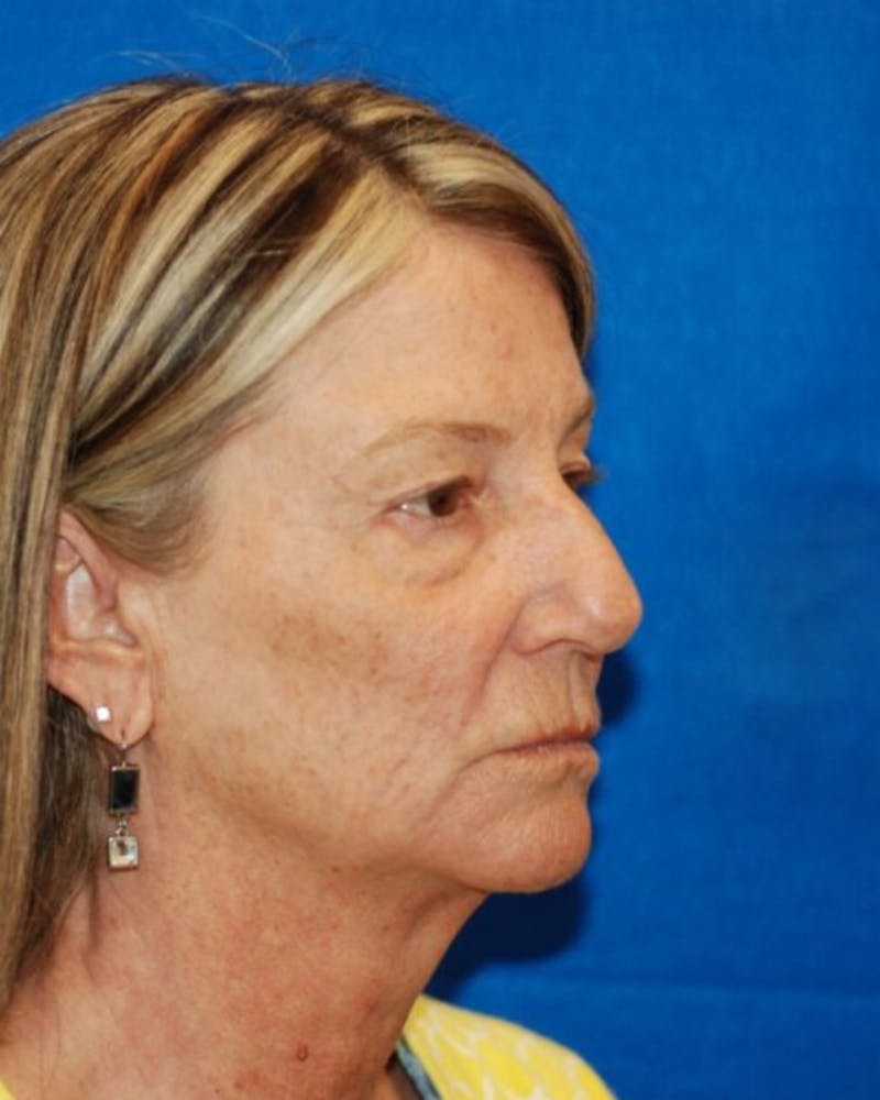 Eyelid Surgery Before & After Gallery - Patient 302087 - Image 5