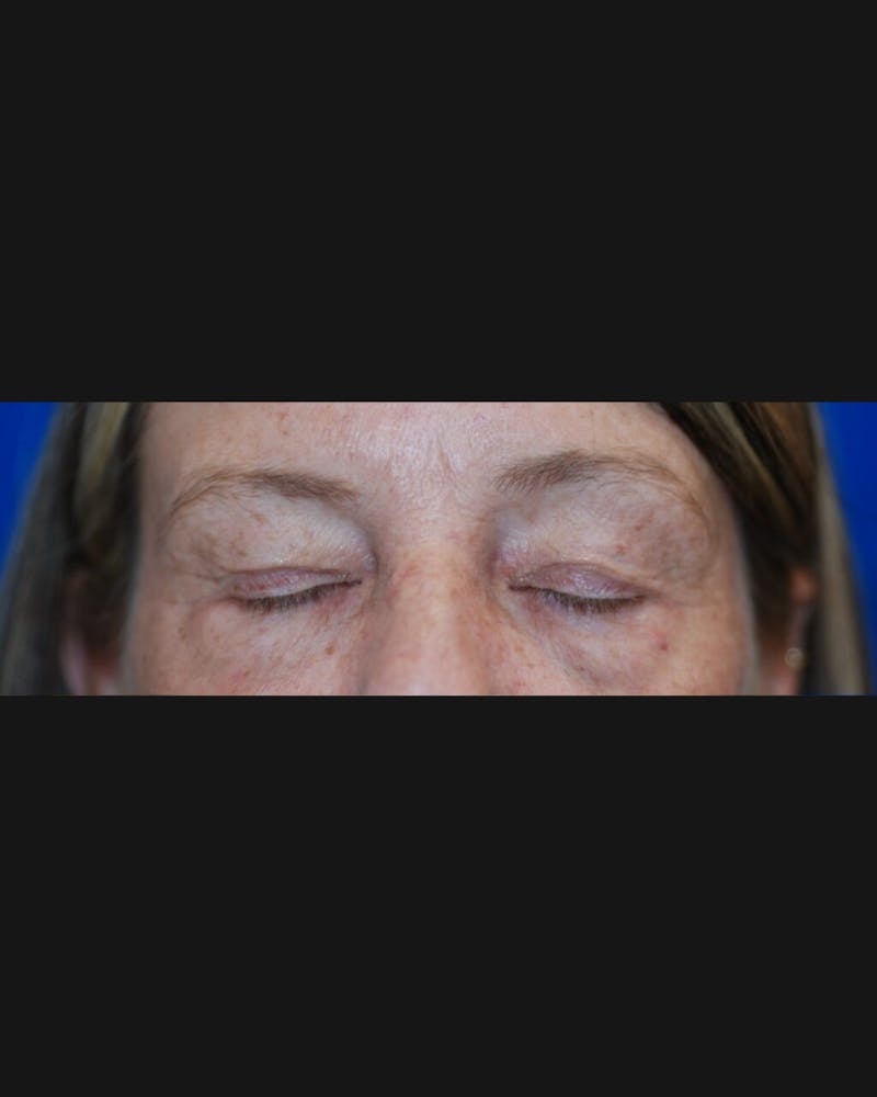 Eyelid Surgery Before & After Gallery - Patient 302087 - Image 11