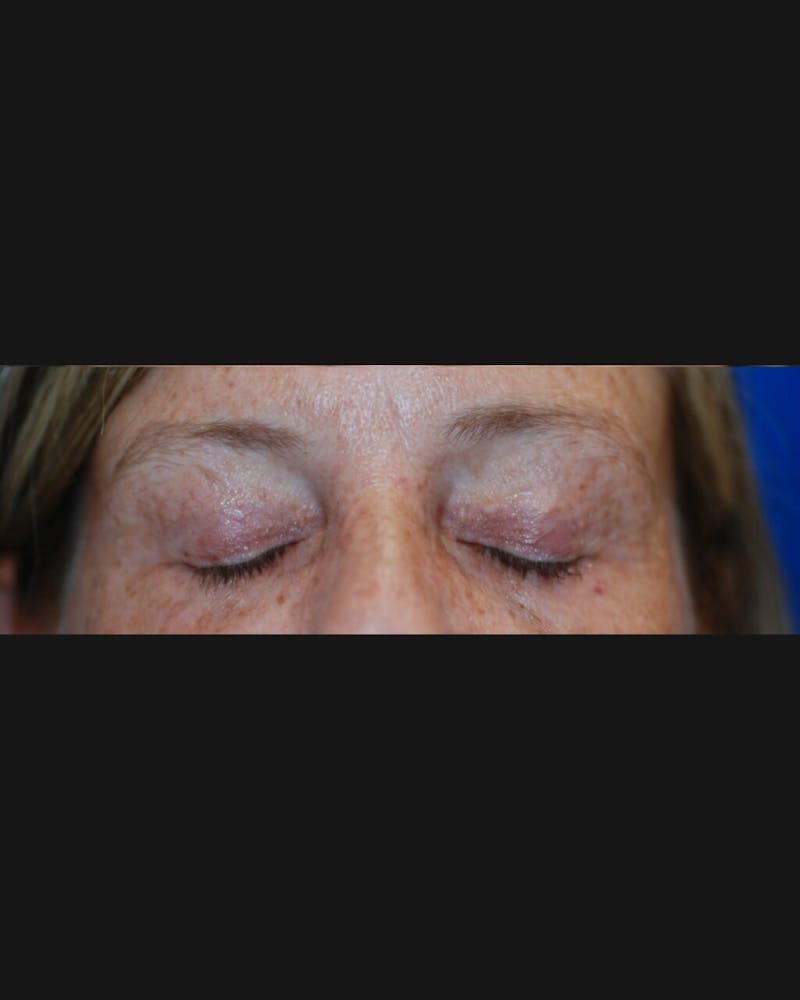 Eyelid Surgery Before & After Gallery - Patient 302087 - Image 12