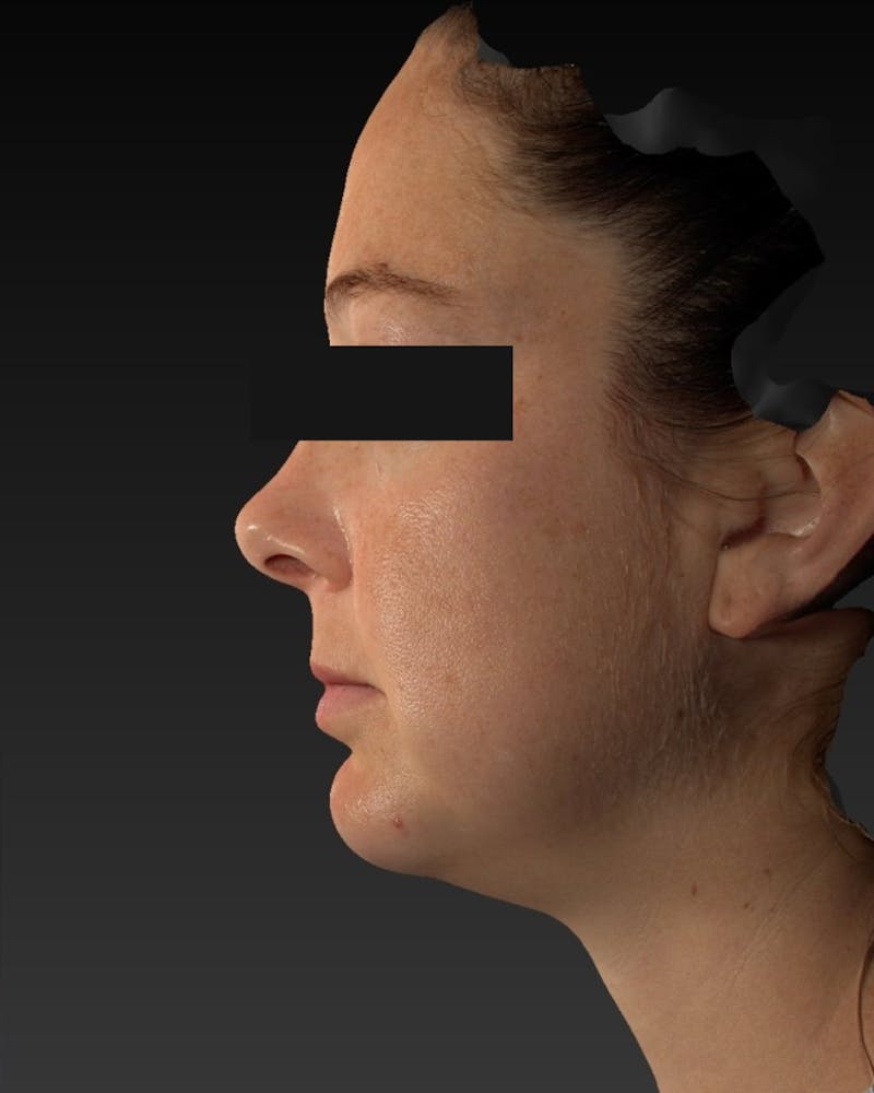 Chin Implant Before & After Gallery - Patient 105345 - Image 6