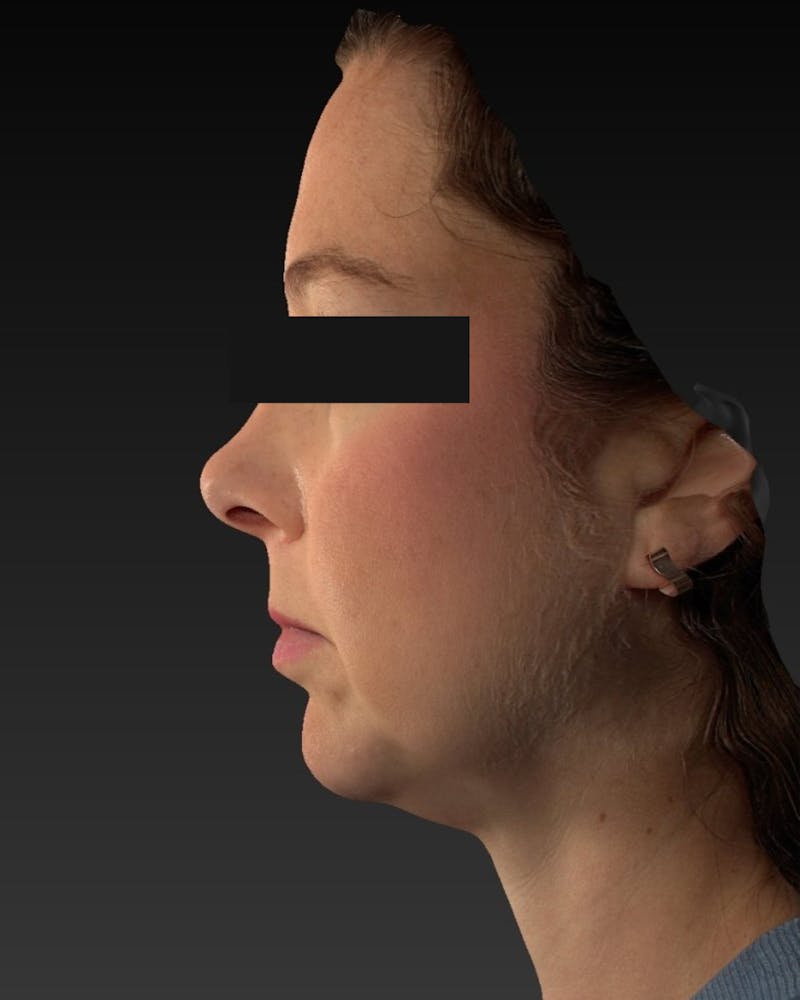 Chin Implant Before & After Gallery - Patient 105345 - Image 5