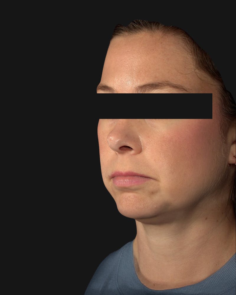 Chin Implant Before & After Gallery - Patient 105345 - Image 3