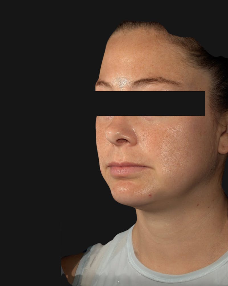 Chin Implant Before & After Gallery - Patient 105345 - Image 4