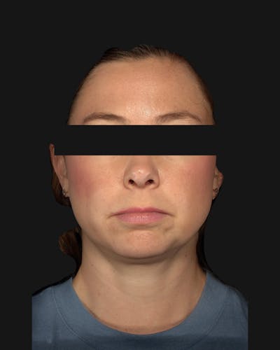 Chin Implant Before & After Gallery - Patient 105345 - Image 1
