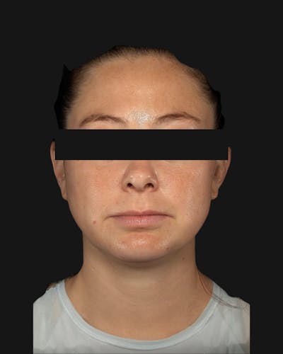 Chin Implant Before & After Gallery - Patient 105345 - Image 2