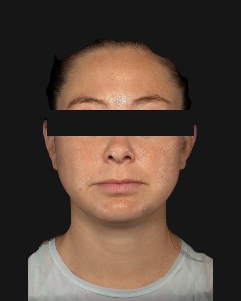 Chin Implant Before & After Gallery - Patient 105345 - Image 2