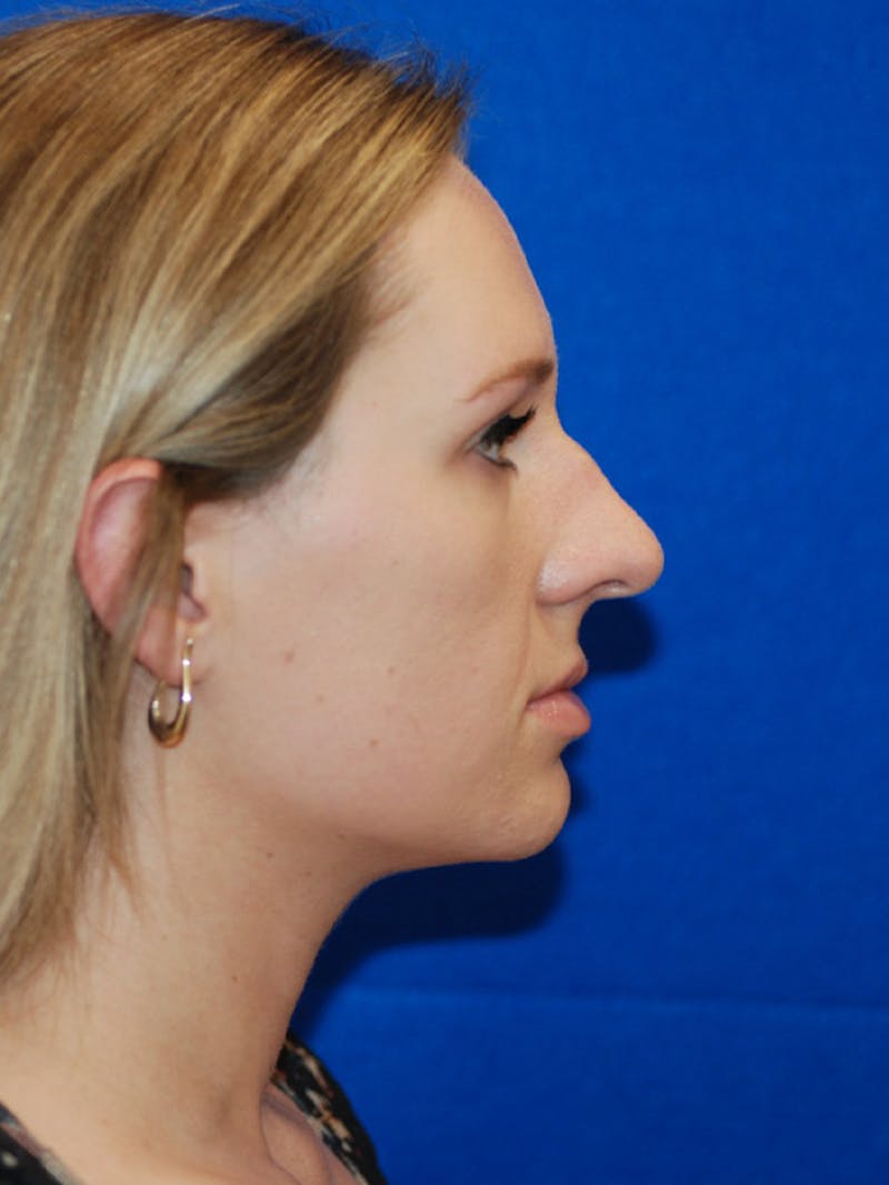 Rhinoplasty Before & After Gallery - Patient 191208 - Image 11