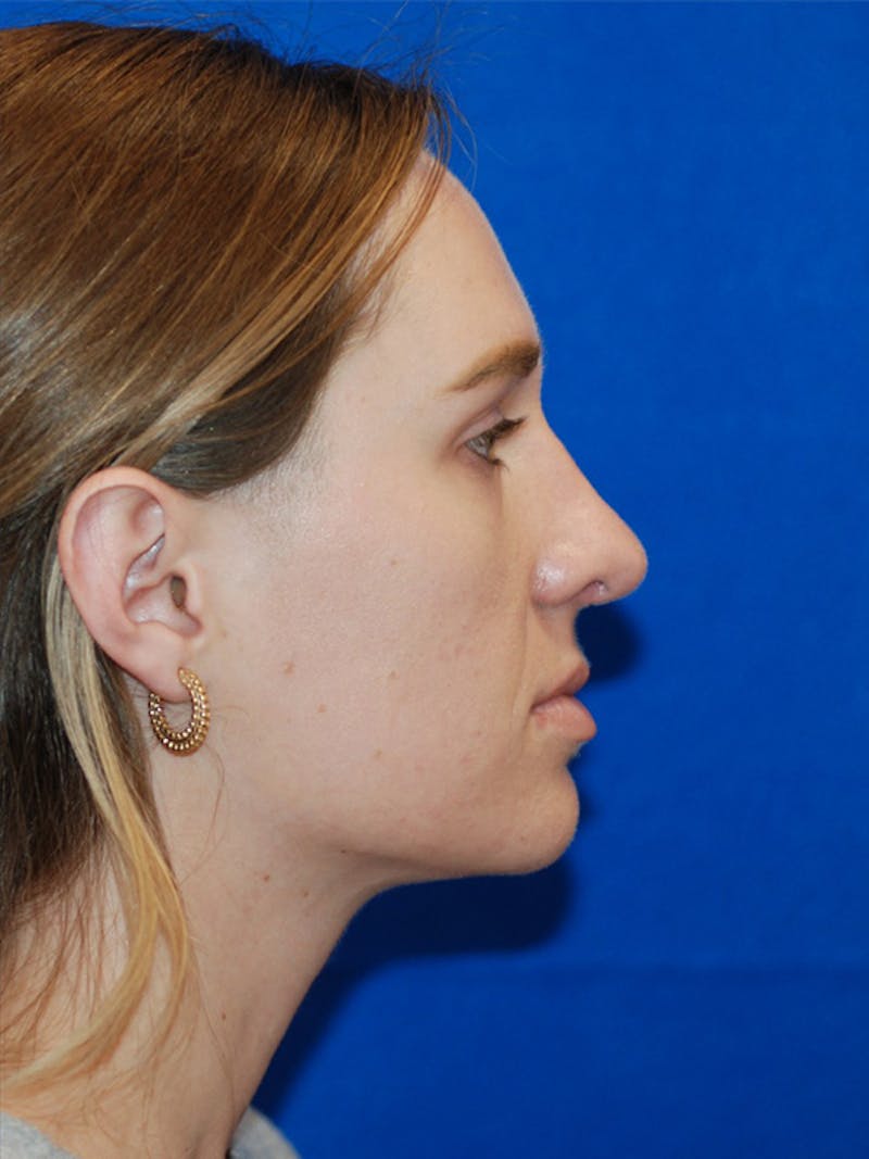 Rhinoplasty Before & After Gallery - Patient 191208 - Image 12
