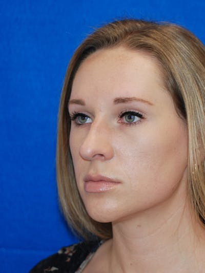 Rhinoplasty Before & After Gallery - Patient 191208 - Image 1