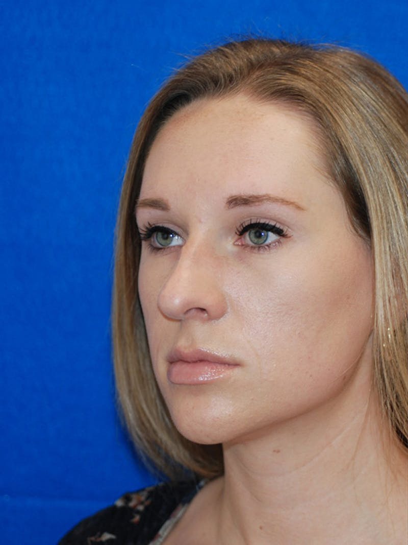 Rhinoplasty Before & After Gallery - Patient 191208 - Image 1