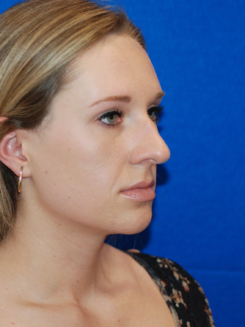 Rhinoplasty Before & After Gallery - Patient 191208 - Image 9