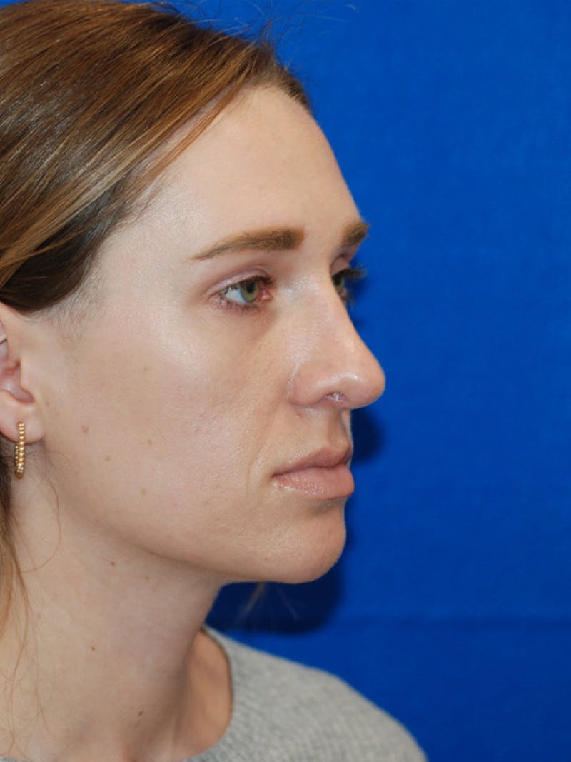 Rhinoplasty Before & After Gallery - Patient 191208 - Image 10