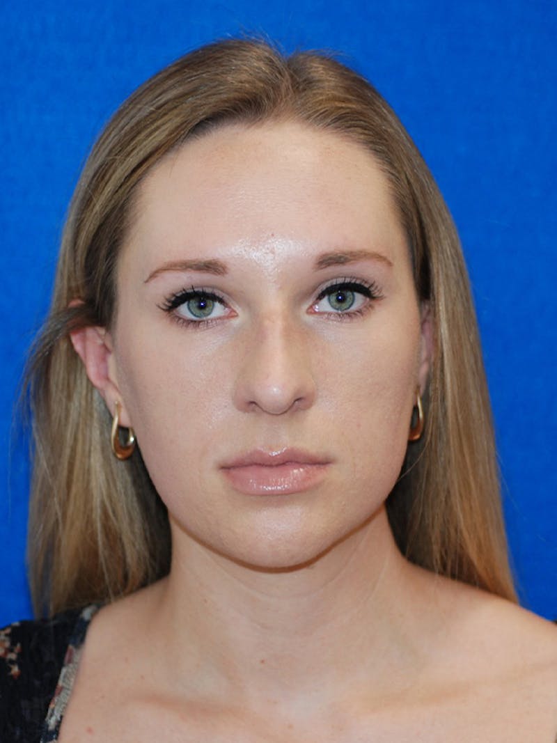 Rhinoplasty Before & After Gallery - Patient 191208 - Image 5