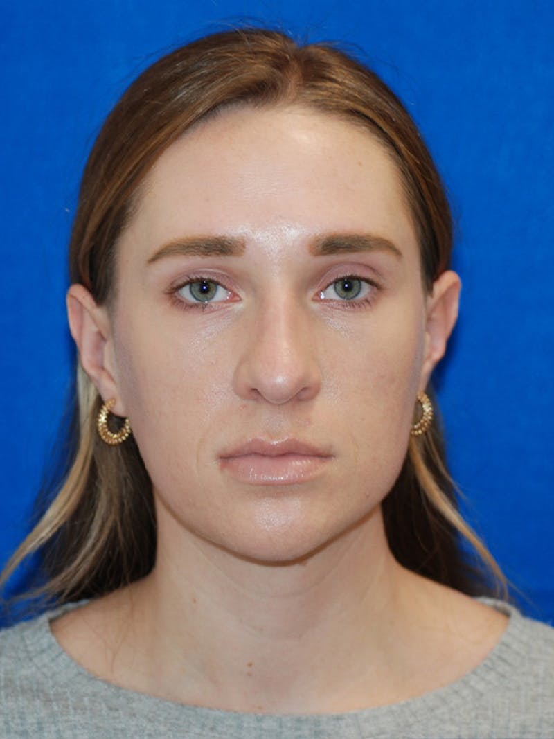 Rhinoplasty Before & After Gallery - Patient 191208 - Image 6