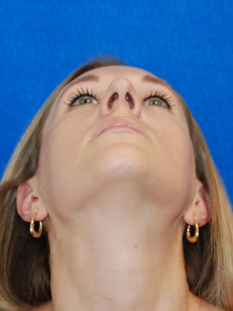 Rhinoplasty Before & After Gallery - Patient 191208 - Image 7