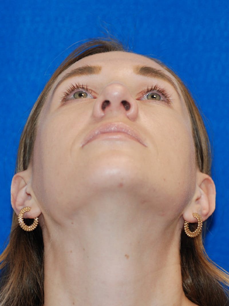 Rhinoplasty Before & After Gallery - Patient 191208 - Image 8