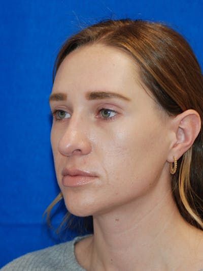 Rhinoplasty Before & After Gallery - Patient 191208 - Image 2