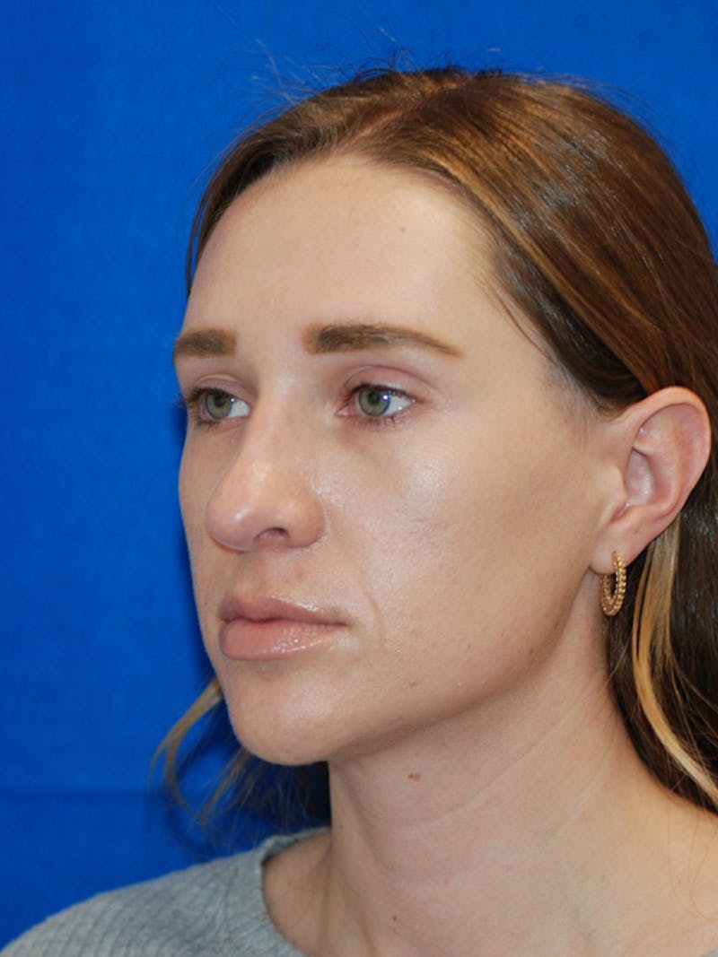 Rhinoplasty Before & After Gallery - Patient 191208 - Image 2