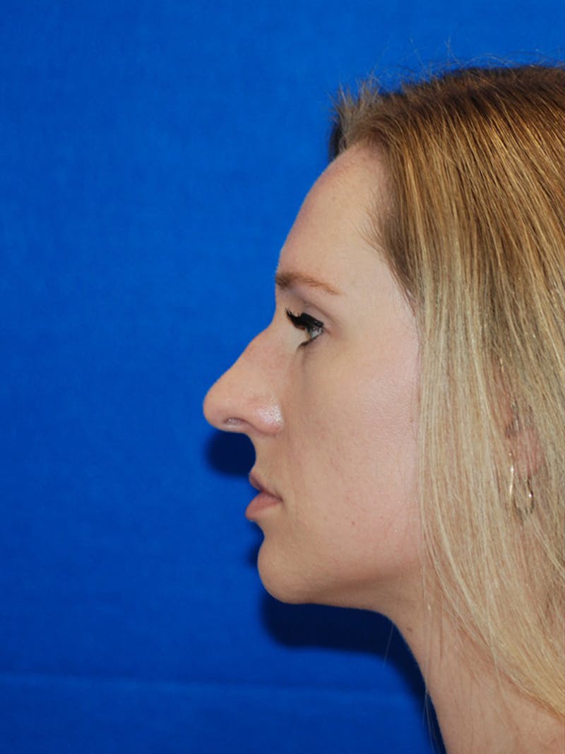 Rhinoplasty Before & After Gallery - Patient 191208 - Image 3