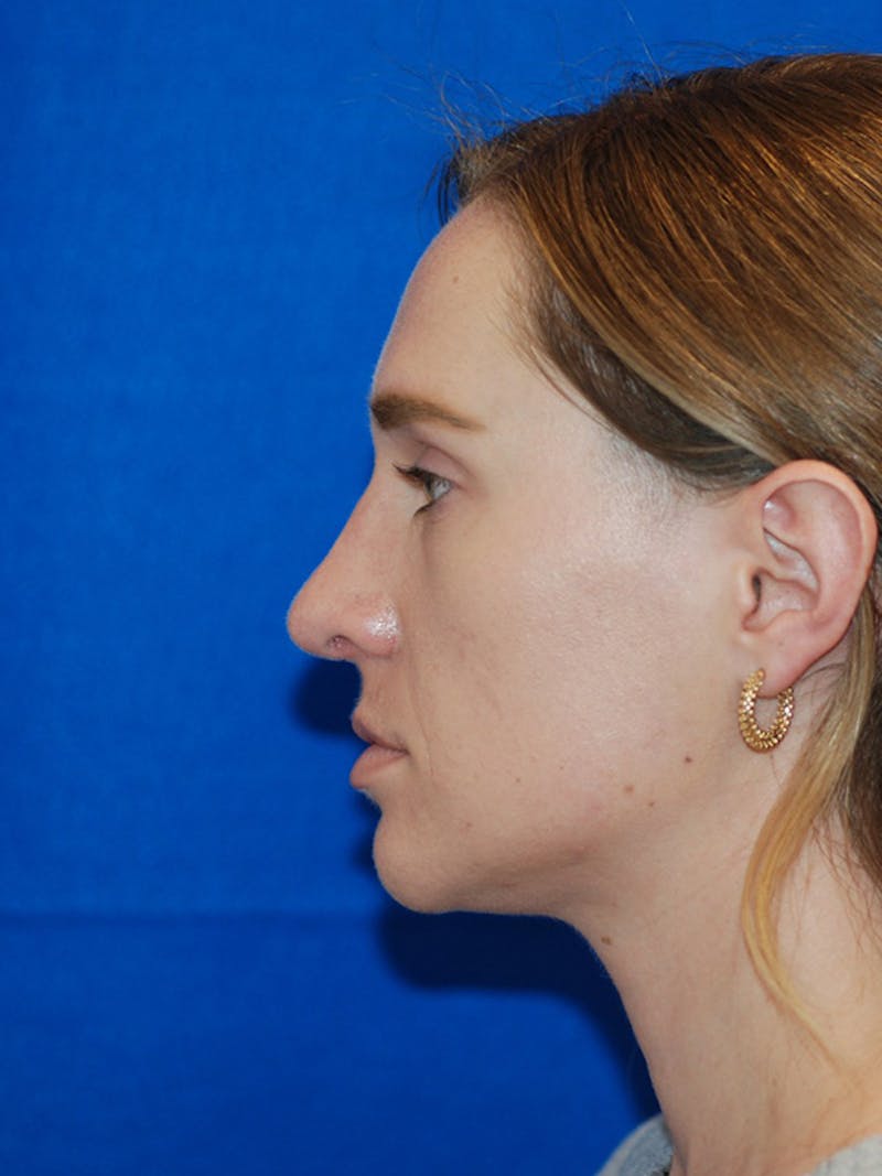 Rhinoplasty Before & After Gallery - Patient 191208 - Image 4