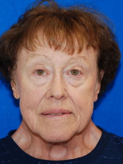 Eyelid Surgery Before & After Gallery - Patient 216022 - Image 1