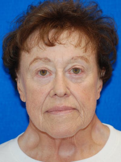 Eyelid Surgery Before & After Gallery - Patient 216022 - Image 2