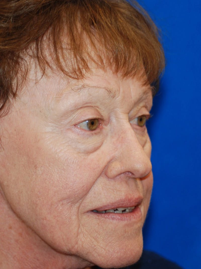 Eyelid Surgery Before & After Gallery - Patient 216022 - Image 3