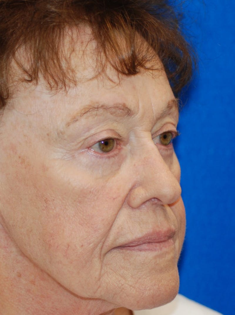 Eyelid Surgery Before & After Gallery - Patient 216022 - Image 4