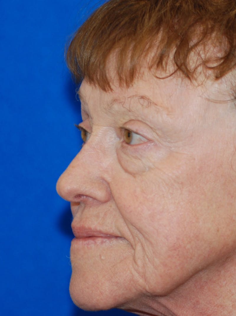 Eyelid Surgery Before & After Gallery - Patient 216022 - Image 5