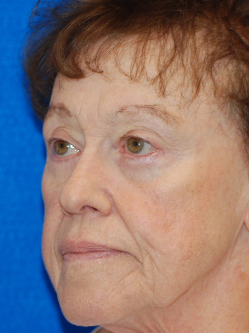Eyelid Surgery Before & After Gallery - Patient 216022 - Image 6