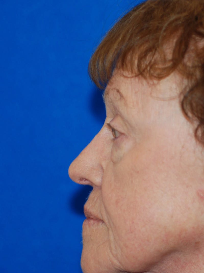 Eyelid Surgery Before & After Gallery - Patient 216022 - Image 7