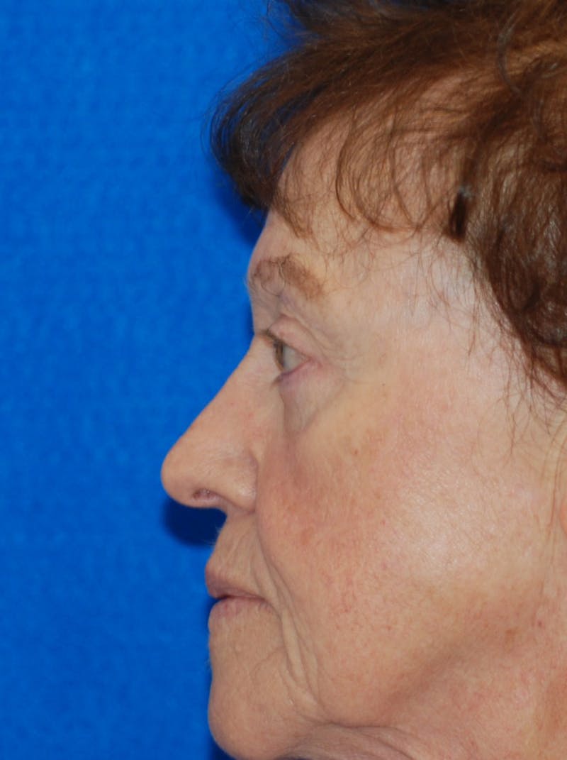 Eyelid Surgery Before & After Gallery - Patient 216022 - Image 8