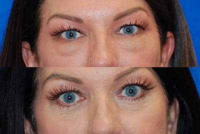 Eyelid Surgery Before & After Gallery - Patient 402947 - Image 1