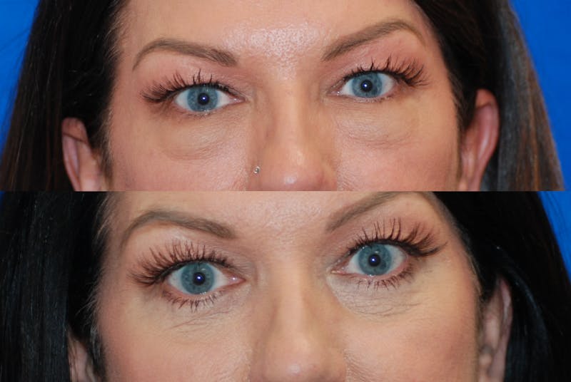 Eyelid Surgery Before & After Gallery - Patient 402947 - Image 1