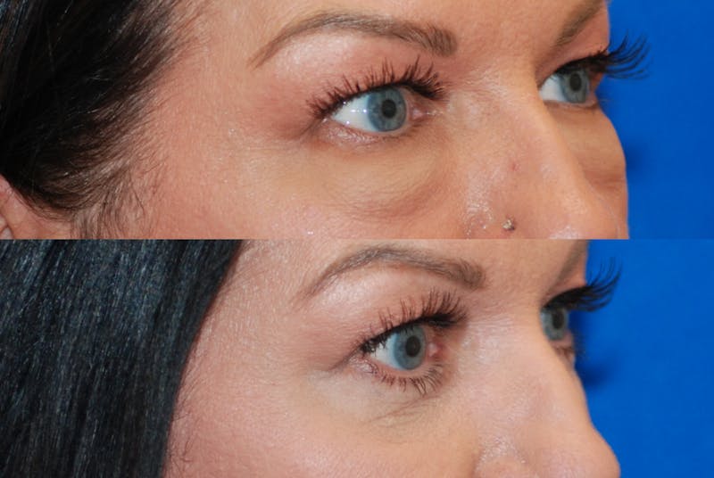Eyelid Surgery Before & After Gallery - Patient 402947 - Image 3