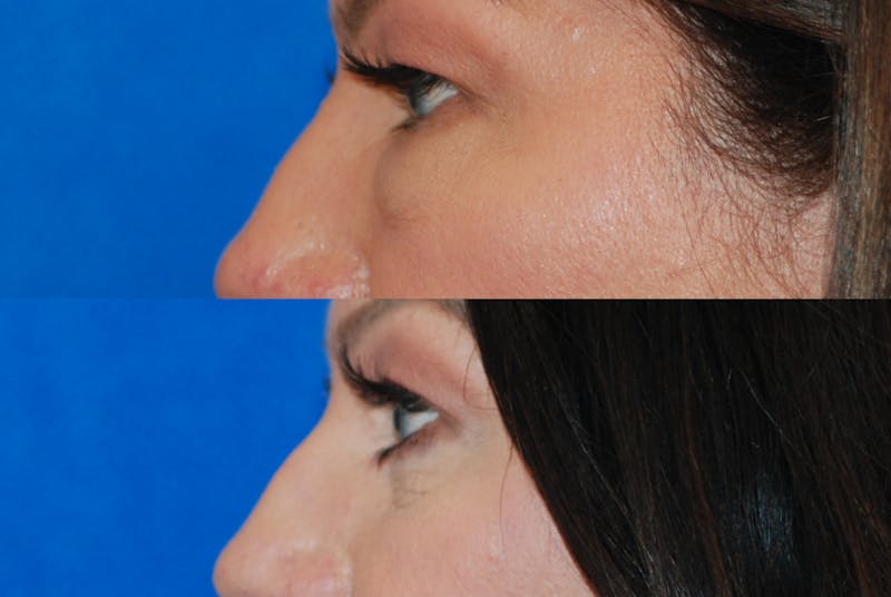 Eyelid Surgery Before & After Gallery - Patient 402947 - Image 6
