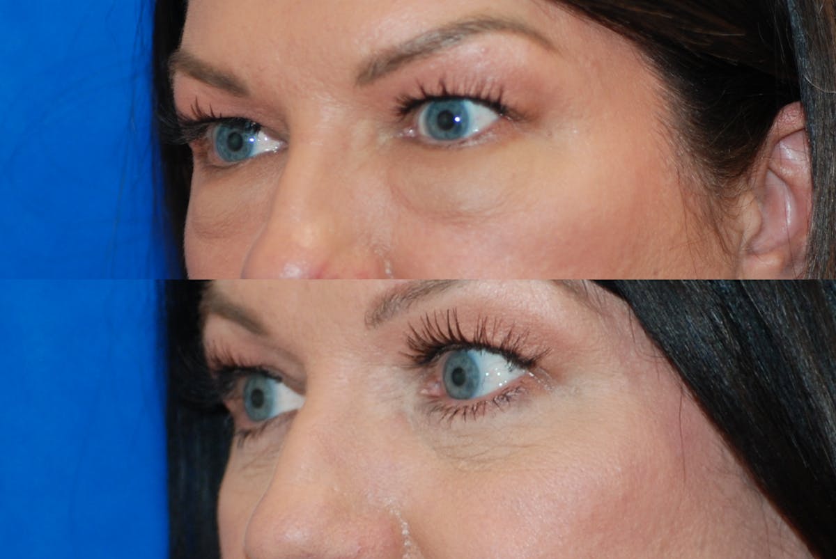 Eyelid Surgery Before & After Gallery - Patient 402947 - Image 4