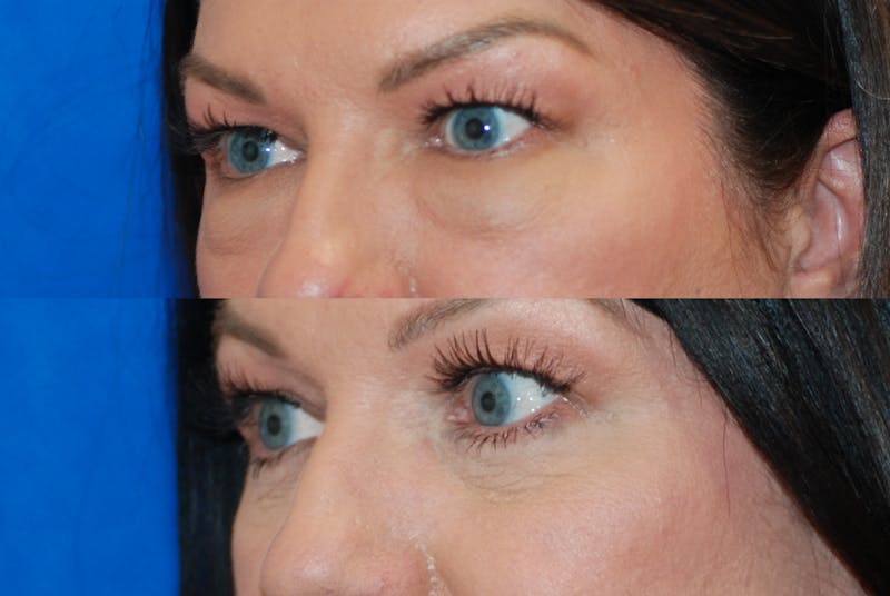 Eyelid Surgery Before & After Gallery - Patient 402947 - Image 4