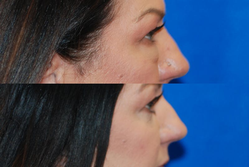 Eyelid Surgery Before & After Gallery - Patient 402947 - Image 5