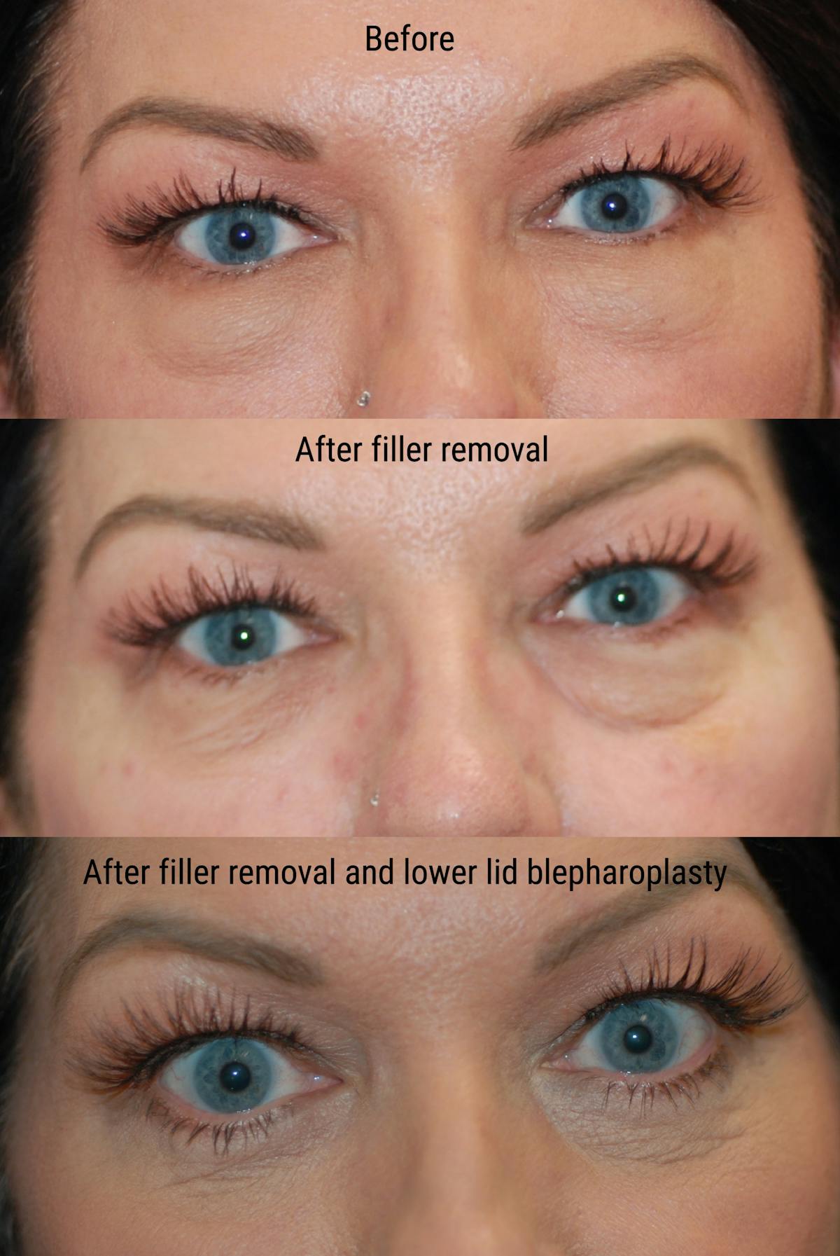 Eyelid Surgery Before & After Gallery - Patient 402947 - Image 2